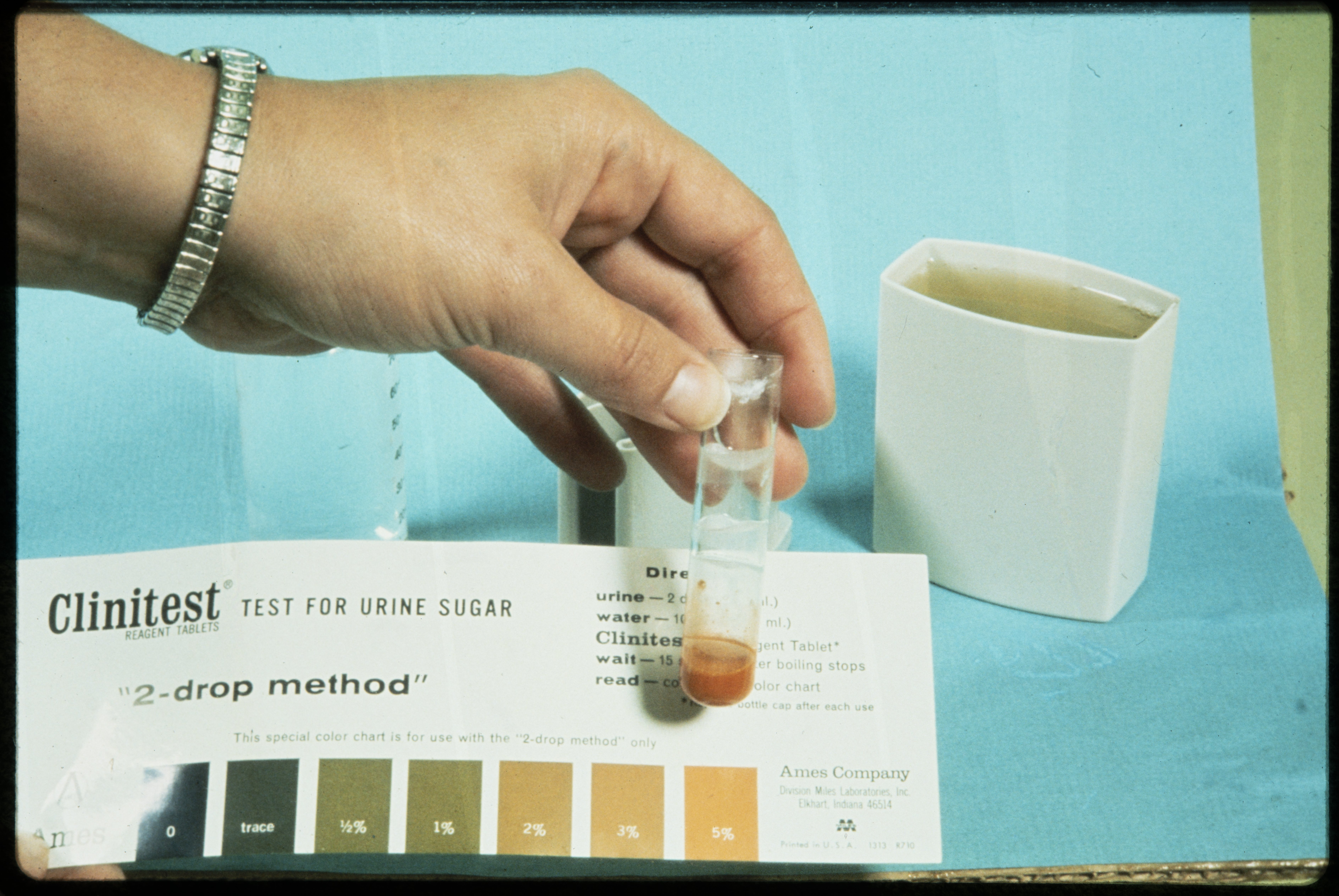 Urine for sugar test